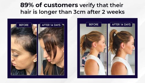 🌿 Odeiun™ Natural Hair Regrowth Spray – 70% OFF Ends Tonight! 🔥