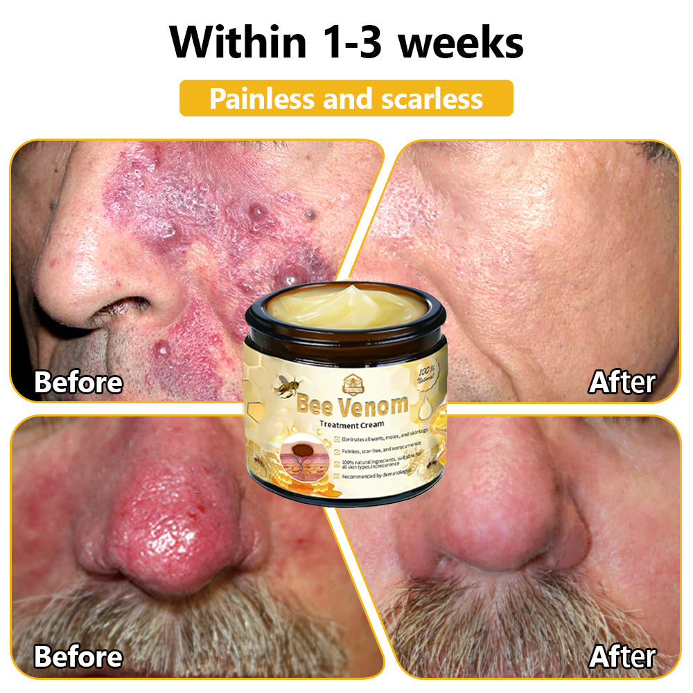 𝗧𝗟𝗢𝗣𝗔® Bee Venom Skin Treatment Cream (AAD Recommended👨‍⚕️)💖💟