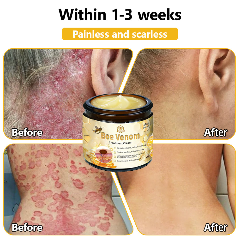 𝗧𝗟𝗢𝗣𝗔® Bee Venom Skin Treatment Cream (AAD Recommended👨‍⚕️)💖💟