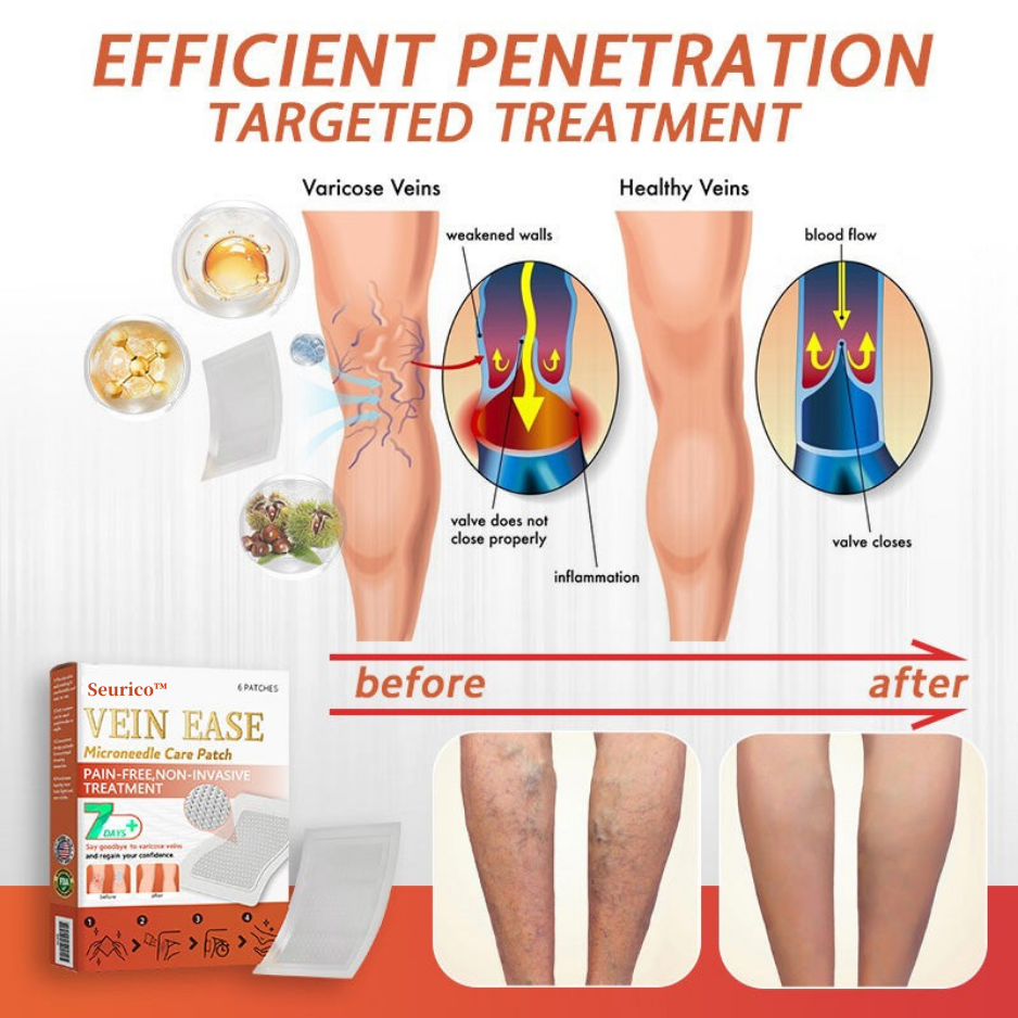 【Last Day Promotion 80% OFF】FDA Official: Seurico™ Vein Ease Microneedle Care Patch(For Spider Veins, Varicose Veins, Swelling & Leg Fatigue)
