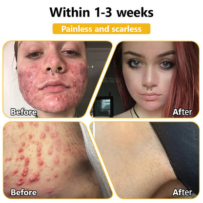 𝗧𝗟𝗢𝗣𝗔® Bee Venom Skin Treatment Cream (AAD Recommended👨‍⚕️)💖💟