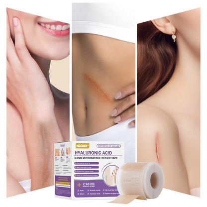 ✅Official Store |NEGUSY® Hyaluronic Acid Nano Microneedle Repair Tape🏥(Treatment of old and new scars, reduction of surgical scars, stretch marks, keloids, acne, burns, warts, dermatomes and varicose veins)