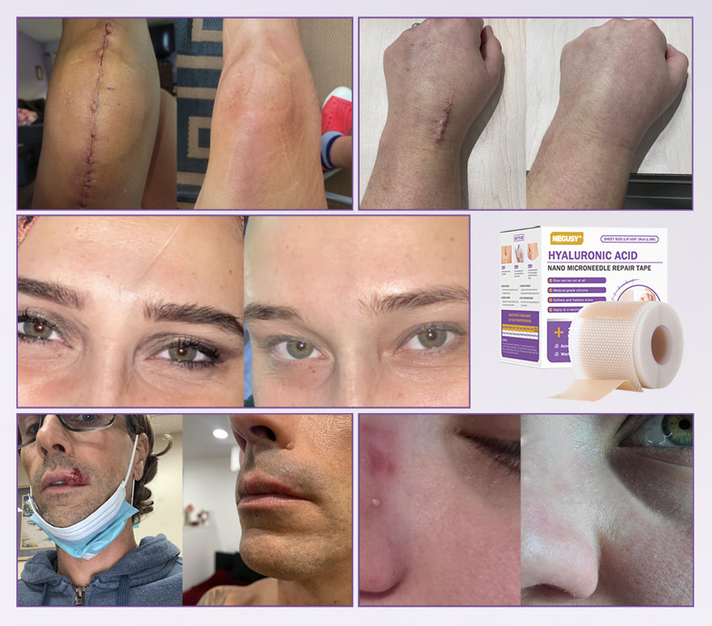 ✅Official Store |NEGUSY® Hyaluronic Acid Nano Microneedle Repair Tape🏥(Treatment of old and new scars, reduction of surgical scars, stretch marks, keloids, acne, burns, warts, dermatomes and varicose veins)