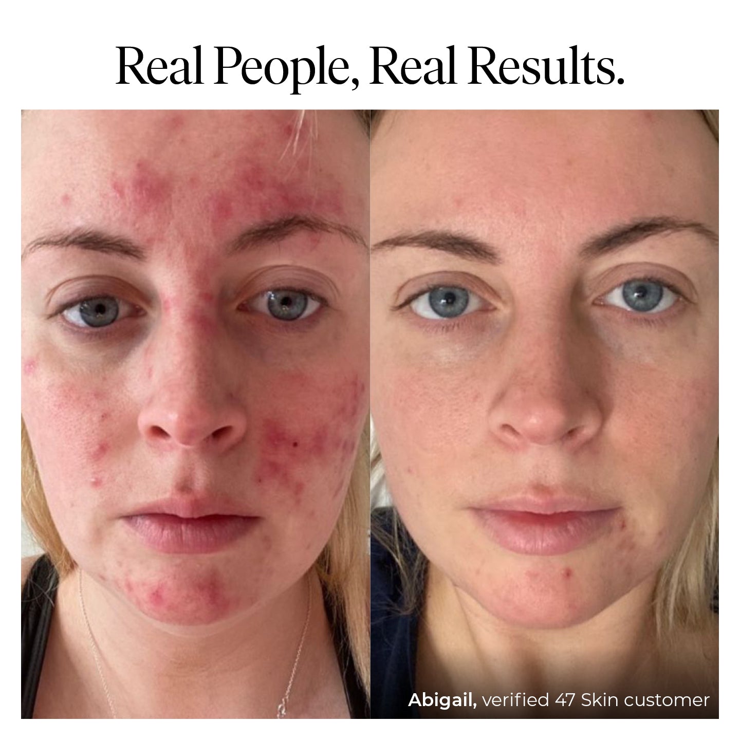 47 SKIN Aura™ Anti-Blemish & Scar Repair Serum